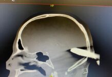 ¡De no creer!, esta es la radiografía del taxista al que le clavaron una cruceta en la cabeza en una riña