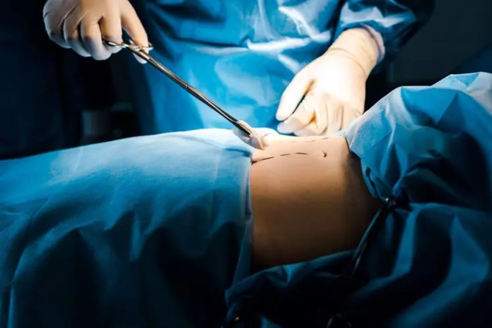 Liposuccion